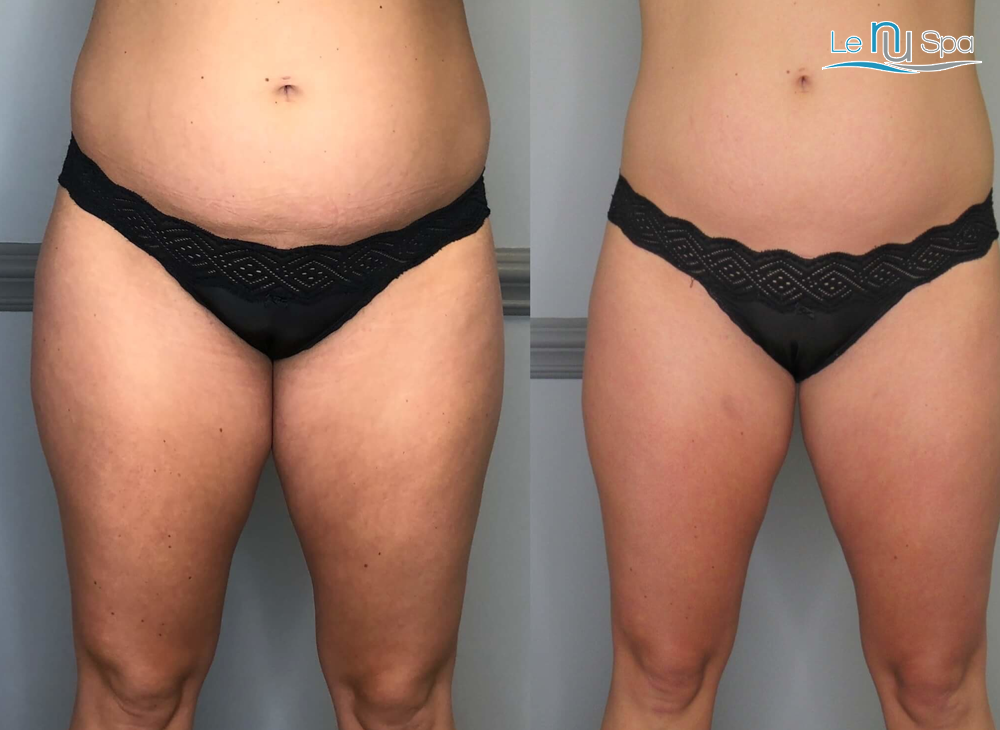 CRYOSKIN Toning - 10-Pack