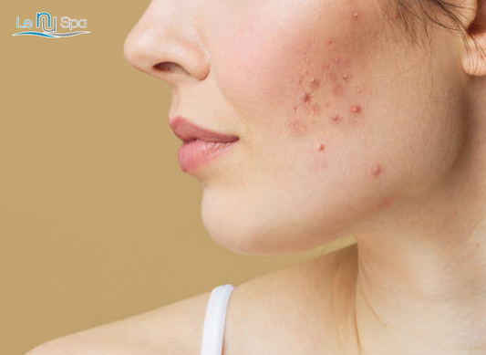Acne Facial