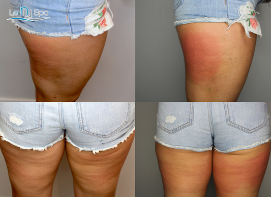 Membership CRYOSKIN Toning