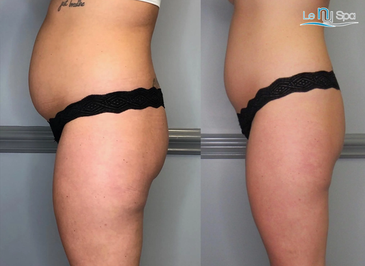 Cryo Slim & Tone - 5 Sessions Special