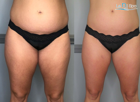 CRYOSKIN Toning - 10-Pack