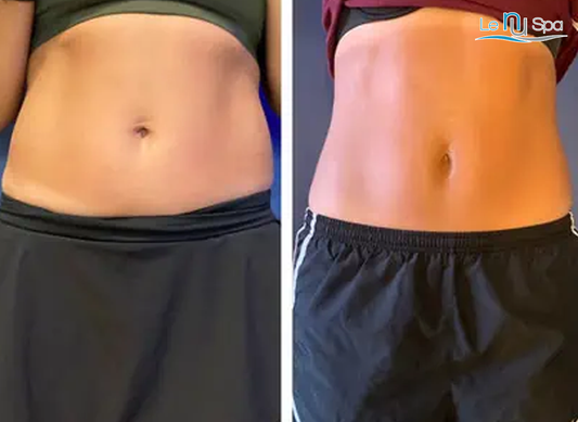 Cryo Slim & Tone - 10 Sessions Special