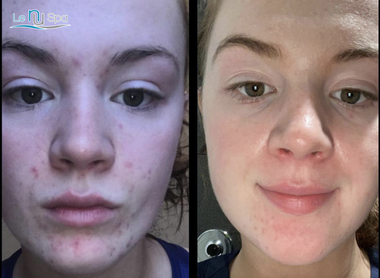 Intro Plason PlasmaFacial