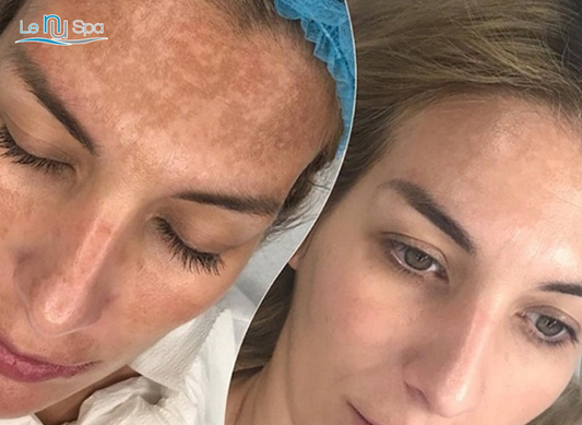 SQT Biomicroneedling - 10 sessions