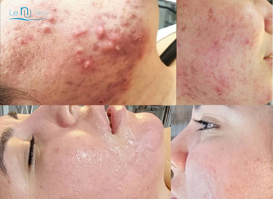 SQT Biomicroneedling - Holiday Special 10 sessions