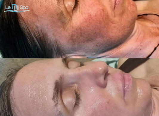 SQT Biomicroneedling - Holiday Special 4 sessions