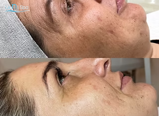 SQT Biomicroneedling